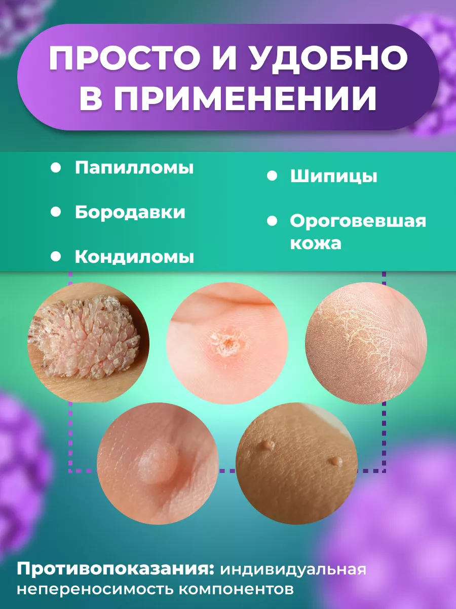 Лечение бородавок и остроконечных кондилом - просто и эффективно | школаселазерновое.рф