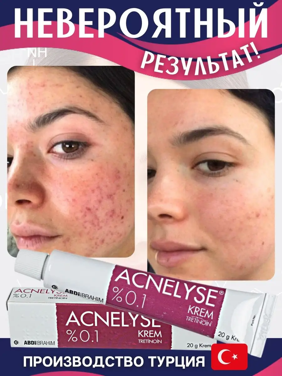 Крем от акне от прыщей ACNELYSE купить по цене 2 125 ₽ в интернет ...
